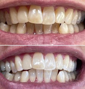 Tanden bleken voor en na Dokkum